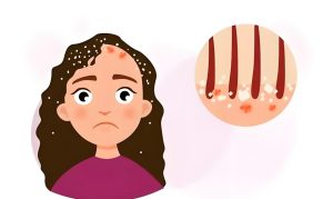 Read more about the article 頭皮屑！“雪花紛飛”怎麼辦？